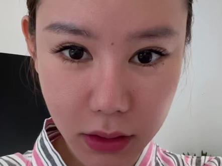 #变美那些事 一整个过程分享#植发手术 #不剃发长发种植