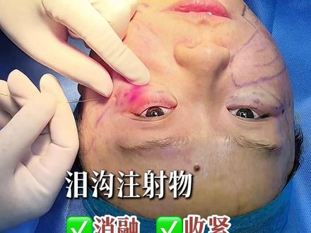 1470超微光取出泪沟注射物 #面部提升 #抗衰 #泪沟 #1470超微光 #变美
