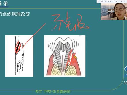 牙周炎的临床表现与组织病理学改变的关系已经给大家总结好了,一起来学习吧#口腔 #知识点总结 #医考 #执业医师考试