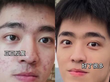 科学抗炎✅内调外养搞定痘肌⁉️养成不长痘体质#油痘肌 #拯救痘痘肌 #抗炎 #内调外养 #干货分享