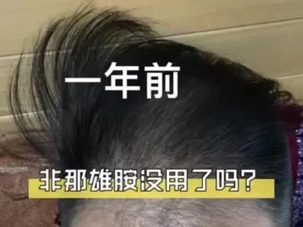 你们头发都还好吗?#拯救发际线 #头发稀疏