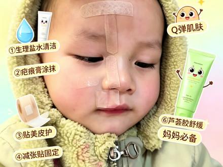 减张贴贴美皮护疤痕膏怎么搭配使用?个人护理方法可以参考一下🫶#宝宝脸部受伤怎么处理 #宝宝脸上受伤如何不留疤 #儿童脸部缝针 #疤痕护理 #宝宝疤痕