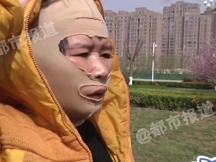51岁大姐被熟人介绍,做拉皮术后张不开嘴。医生:持续3个月以上会缓解#河南dou知道