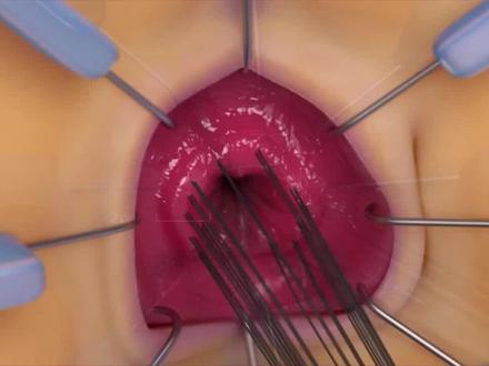 家里宝宝经常#便秘 ,有可能是先天性巨结肠!#健康