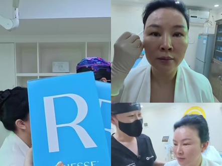今日分享:再生抗衰CaHA中TOP1:芮得怡(Radiesse,也常称瑞德喜),主打硬支撑、骨相塑形、抗馒化,适合想打造立体轮廓的人。#第一视角 #医生日常 #vlog十亿流量扶持计划 #馒化脸 #抗衰