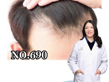一条视频,告诉你医生自己是怎么样给自己治病的#科普 #掉发 #非那雄胺 #雄脱 #脱发