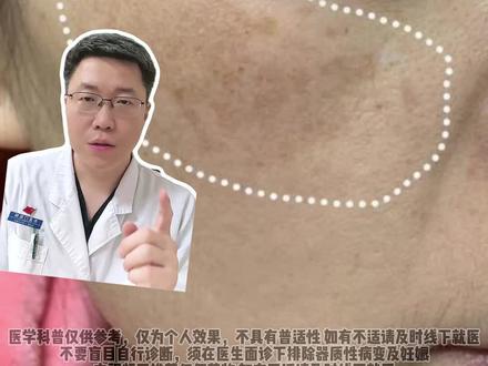 黄褐斑显黑又显老!淡斑记好简单两招 #医学科普 #护肤 #黄褐斑 #淡斑 #关爱女性健康