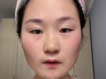 取鼻假体第六天 肿胀完全下去 鼻梁塌陷🍃
