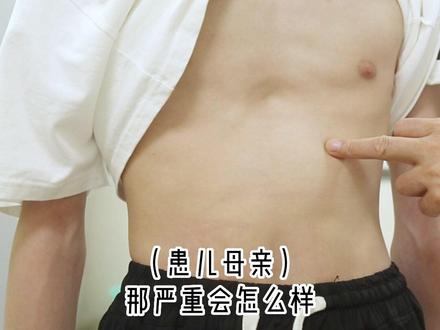 15岁少年胸腔凹陷,形似“漏斗”,这是怎么回事呢?#漏斗胸 #医学科普 #妇幼健康科普 #原创