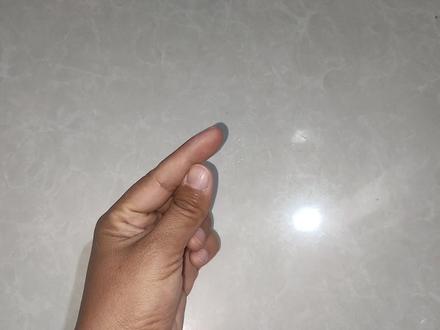 手上扎刺了,别用针挑教你一招,让刺自己跑出来