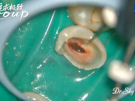 #显微根管治疗 #牙医日常 #口腔科普 #长春同城 显微根管治疗