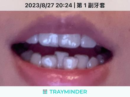 我暂且封隐形牙套为世界上最伟大的发明#隐形牙套 #时代天使