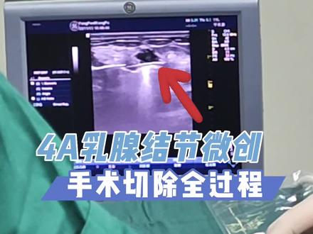 4A乳腺结节微创旋切全过程。#乳腺结节 #乳腺结节4A #乳腺微创手术