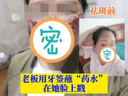 #杭州女子花2万祛斑惨遭毁容 经检测“神秘药水”里含有违禁物质