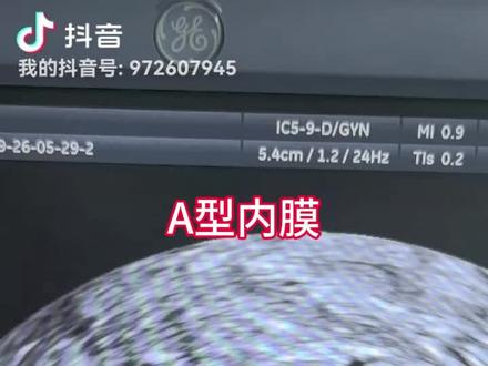 #超声影像 #超声学习 备孕期子宫内膜最好的是A型,如果增殖期也就是排卵前期,内膜提前到了B型甚至到C型,受孕率会降低,A型是受精卵着床条件最好的