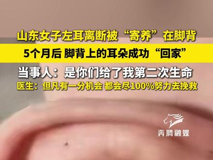 山东女子左耳离断被“寄养”在脚背 5个月后 脚背上的耳朵成功“回家” 当事人:是你们给了我第二次生命 医生:但凡有一分机会 都会尽100%努力去挽救