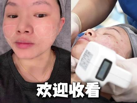 年前必做医美项目-钻石超塑vlog ✨inmode钻石超塑简直就是大救星!
✅面部脂肪堆积
✅下颌线轮廓模糊
✅双下巴明显
#姐的美都是姐应得的#钻石超塑 #双下巴消失术 #肉肉脸 #年前变美计划