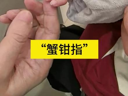 每一个多指手术都有自己的最佳摘除时间#多指切除术 #蟹钳指 #多指手术年龄 #西安市儿童医院骨科王小玮