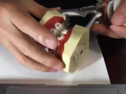 双钥匙曲关间隙结扎#正畸 #零基础 #弓丝弯制