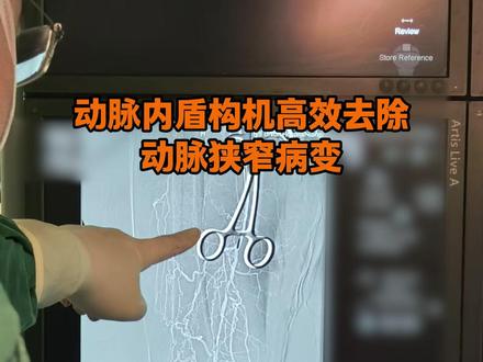 动脉内盾构机高效去除动脉狭窄病变#动脉狭窄 #武汉协和医院 #血管外科王剑