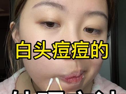 白头痘痘处理方法#挤痘痘 #痘痘#闭口粉刺