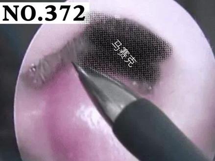 鼻孔内的疙瘩,其实是#火疖子 ,可以用这个简单的方法,一天两次即可!#抖医医生 #科普 #皮肤