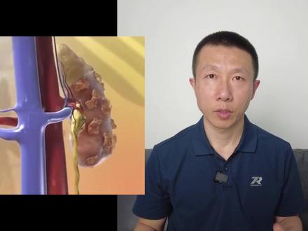 糖尿病会破坏肾脏,如何预防&管理.mp4 #新年囤点专业货 #复工健康指南 #糖尿病 #肾脏 #尿毒症