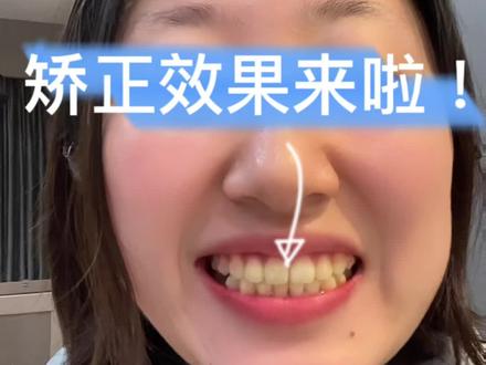 正畸年记来啦😹矫正基本结束啦,给大家看看效果~#正畸 #牙齿矫正 #隐形牙套 #时代天使 #隐适美 @DOU+小助手 @抖音小助手