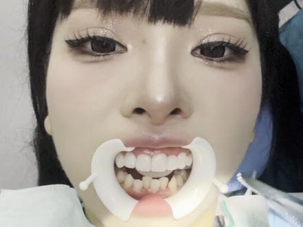 以后终于是网络美女了 #牙贴面 #变美思路 #变美逆袭