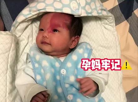 不想宝宝有胎记,要做一下这几点#孕期 #孕晚期