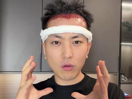 3.11号鼓起勇气去植发了~
#植发手术 #植发疼吗