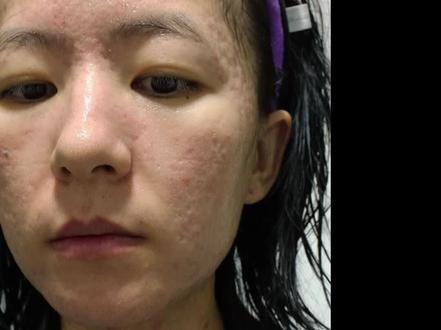 点阵激光掉完疤之后最困扰大家的一定是脸非常红,
包括还有些敏感肌动不动脸红的宝宝也一定很在意皮肤泛红继续修复的方法
刚好趁着点阵激光疤掉了之后的阶段,非常适合来评测一下我自用的3款面膜,看看都是主打修复去红的面膜,到底哪款最好用!
#点阵激光 #点阵修复 #退红面膜 #修复面膜 #拒绝容貌焦虑