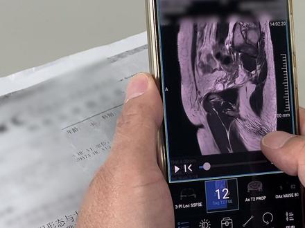 大腿上一个不起眼的肿物,被当作脂肪瘤切除,三年后复发扩切,病理确诊为黏液纤维肉瘤。如今已出现局部转移,肿瘤恶性程度明显升级。此时已不是观望的时候,要尽快规范用药、系统治疗,争取主动权。#抖出健康知识宝藏 #纤维肉瘤 #黏液纤维肉瘤 #肉瘤 #骨肿瘤科沈靖南