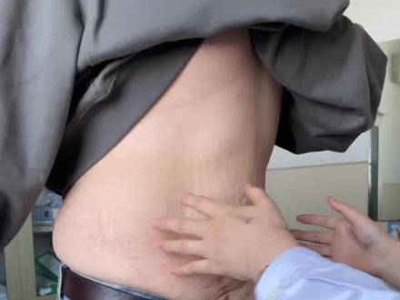 帅哥之前250斤,经过减肥之后,肚子上皮肤组织明显下垂褶皱,这种情况该怎么办呢?#变美逆袭 #皮肤 @抖音小助手