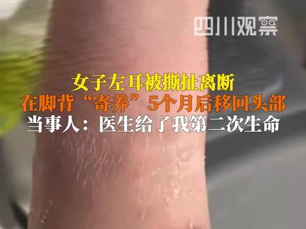 12月4日据齐鲁晚报。今年4月孙女士左耳被扯断,医生将离断的耳朵“寄养”到她的脚背上,5个月后移回头部后,孙女士激动得热泪盈眶:我以为这辈子就这样了,是医生给了我第二次生命,让我有勇气重新面对生活。