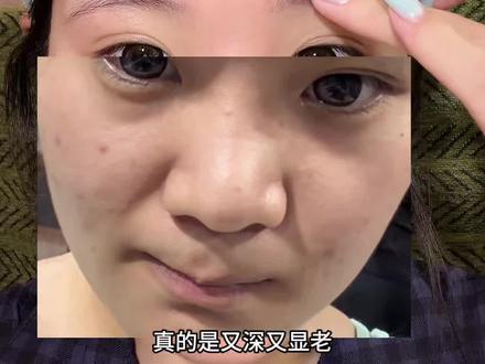 真心建议那些爱侧睡法0️⃣纹深的朋友们试试这个小方法 #法令纹 #淡纹 #护肤 #男生护肤 #变美