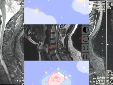 颈椎病年轻化,30多岁神经压迫这么严重