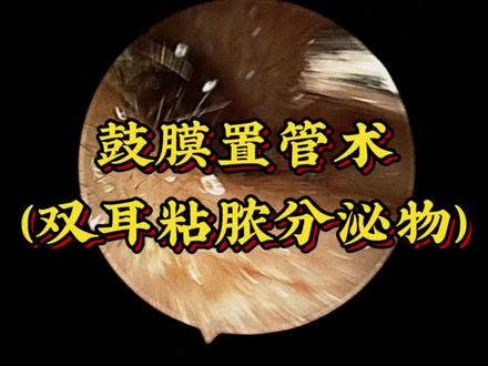 内镜下鼓膜置管术#科普视频仅供参考