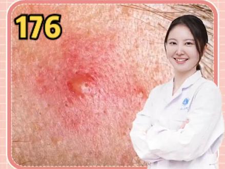 痘痘治疗药物——壬二酸为什么这么火?#医学科普 #痘痘 #壬二酸 #金秋说健康