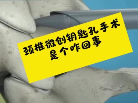 颈椎微创钥匙孔手术Key-hole是咋回事?今天一个视频,门诊复查病例加动画演示讲清楚#颈椎微创#钥匙孔手术 #keyhole #颈椎病#脊柱微创