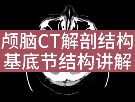 颅脑CT读片基本解剖,基底节组成结构有哪些,对应图像位置讲解