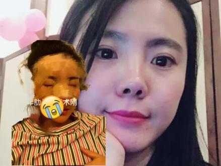 我不建议大家做肋骨👃#肋骨👃避坑#审美提升#塌鼻梁变高鼻梁
