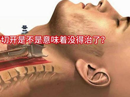 气管切开是否意味着没得治了?