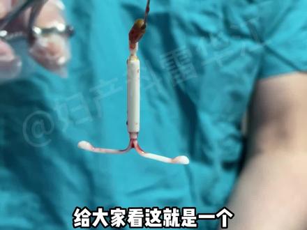 给你看一下,这是刚从患者体内取出来的环,认识它吗?#曼月乐 #腺肌症 #雷华江腺肌症保宫 #手术室日常 #医学科普 #科普一下
