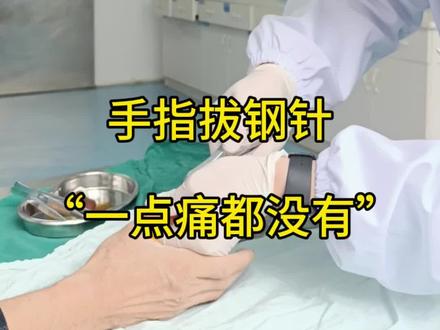 手指拔钢针,其实没这么可怕!#手指骨折 #克氏针 #医学科普 #指骨骨折