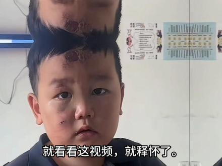 鼻青脸肿的宝宝上人民日报了,明明也受伤了,也很痛,却不哭不闹地跟随着妈妈,眼神坚定勇敢又坚强,令全网感动落泪#人物故事 #创作者扶持计划 #上热搜 #强烈推荐 #真实事件