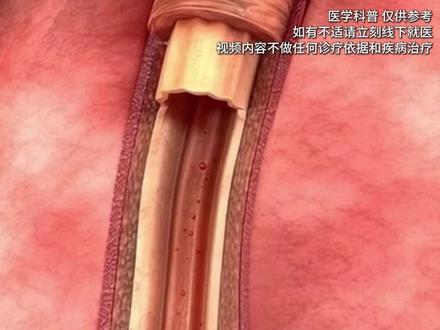 体检报告上的“#颈动脉斑块 或狭窄”,是不是让你心里咯噔一下?别慌,也别乱投医,今天我就来告诉大家,查出这些问题,何时才需要治疗。#血管狭窄 #医学科普 #抖出健康知识宝藏 #我的年度健康盘点
