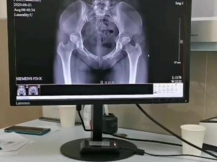 这是一位因怀孕引起了耻骨分离,需要这样处理才可以#暑期知识大作战 #医学科普