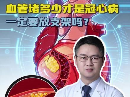 血管堵多少才是冠心病,一定要放支架吗? #血管堵塞 #冠心病 #中老年健康 #抖出健康知识宝藏