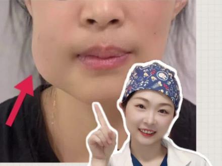 拔完智齿这样做❗️避免肿成猪头#拔智齿 #智齿疼